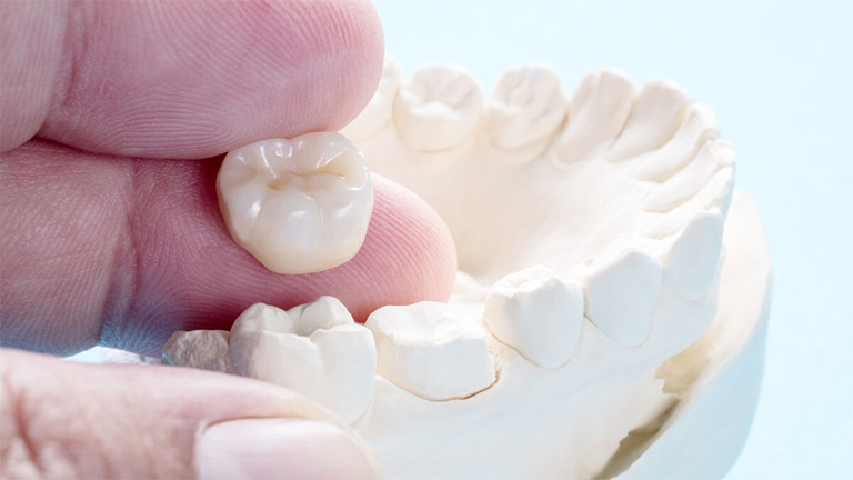 What Is A Dental Crown?