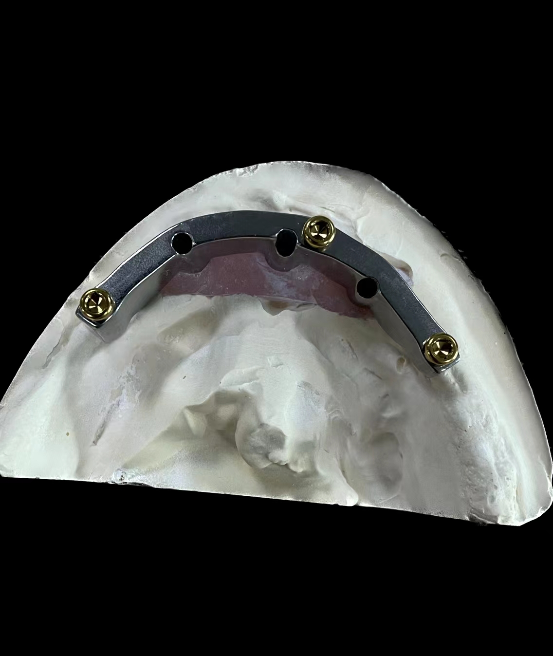 Advancing Dental Implant Technology: Solid vs. Lattice-Structured Titanium Alloy Overdenture Bars