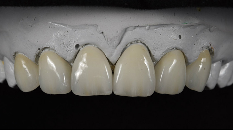 Exploring the Benefits of Outsourcing Dental Lab Work to China