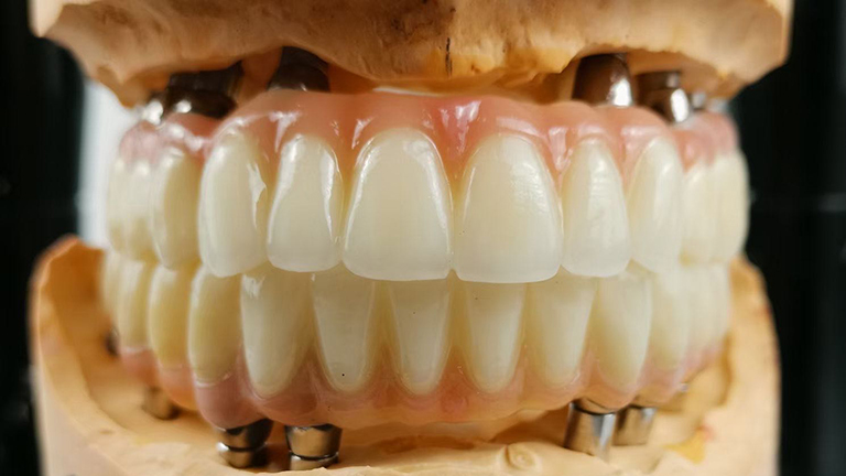 All-on-4 Bridge Frequently Asked Questions