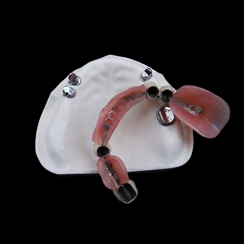 Precision Attachment - TopWay Dental Lab