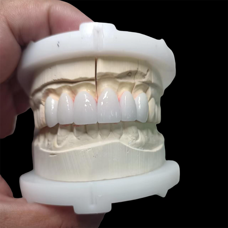 Layered Zirconia Crown and Bridge