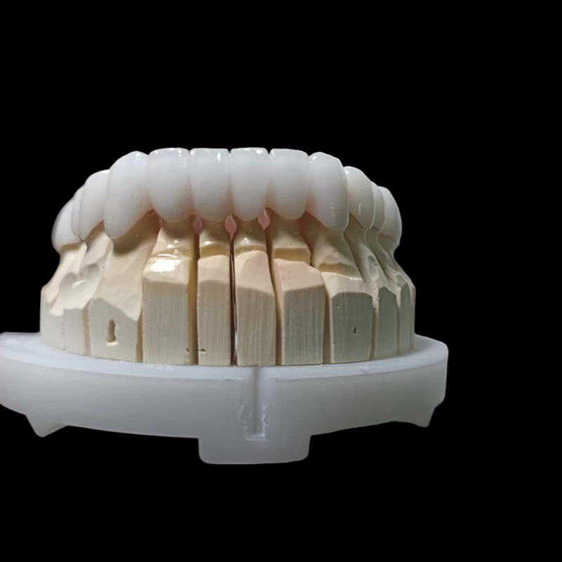 Layered Zirconia Crown and Bridge - Image 2