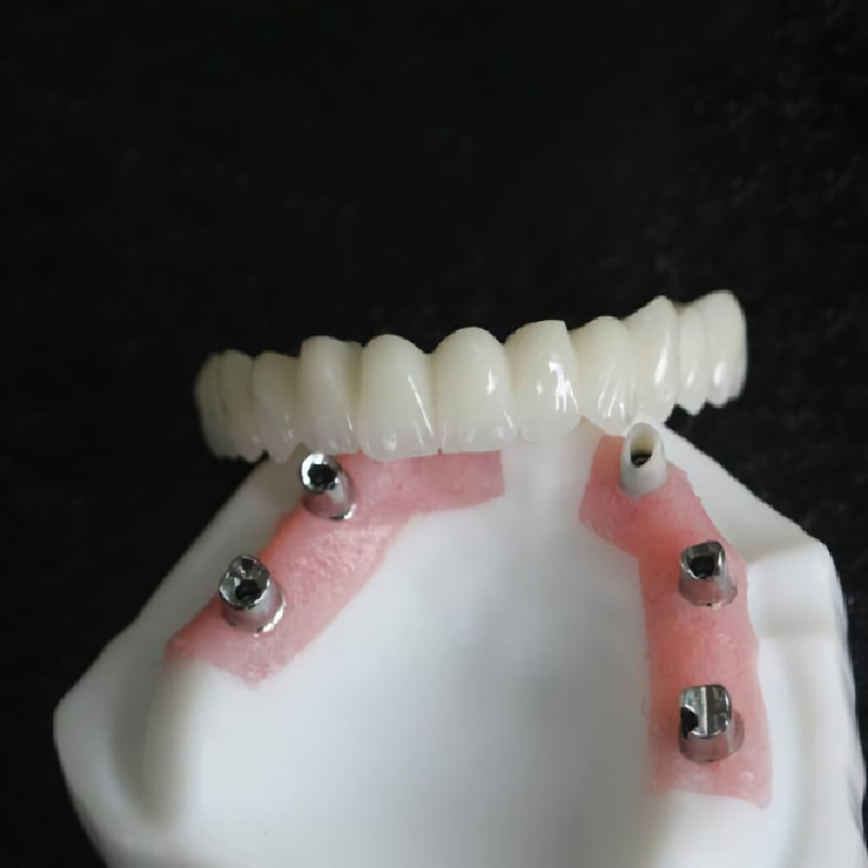 Layered Zirconia Implant Crowns And Bridge - Image 3