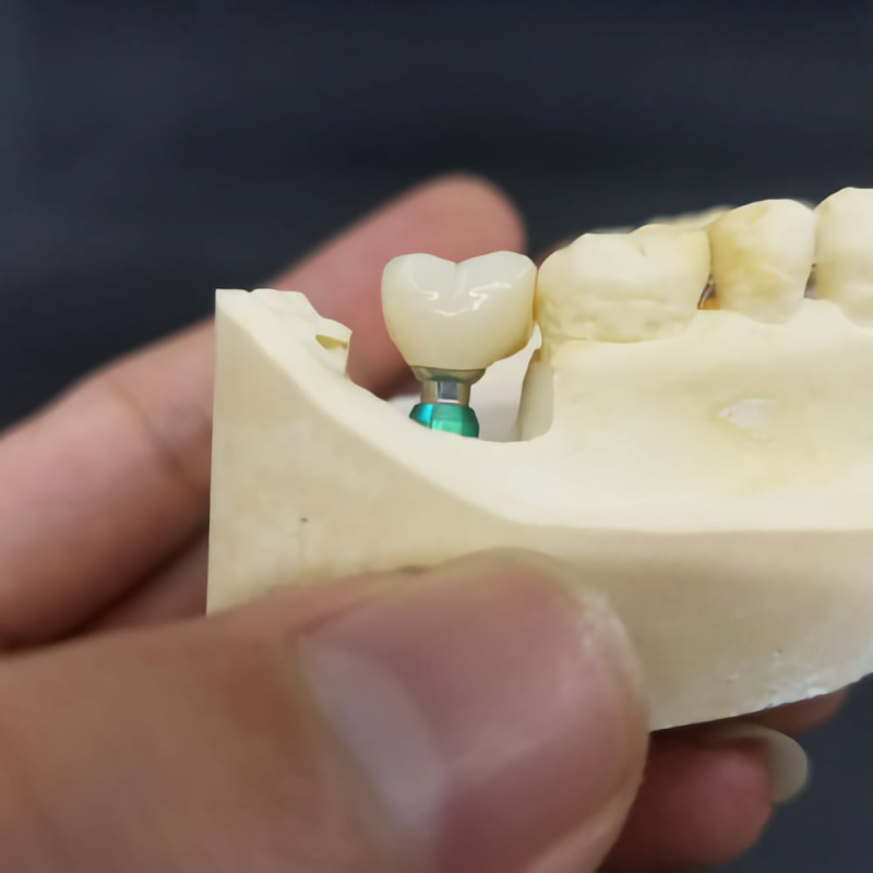 Layered Zirconia Implant Crowns And Bridge - Image 4