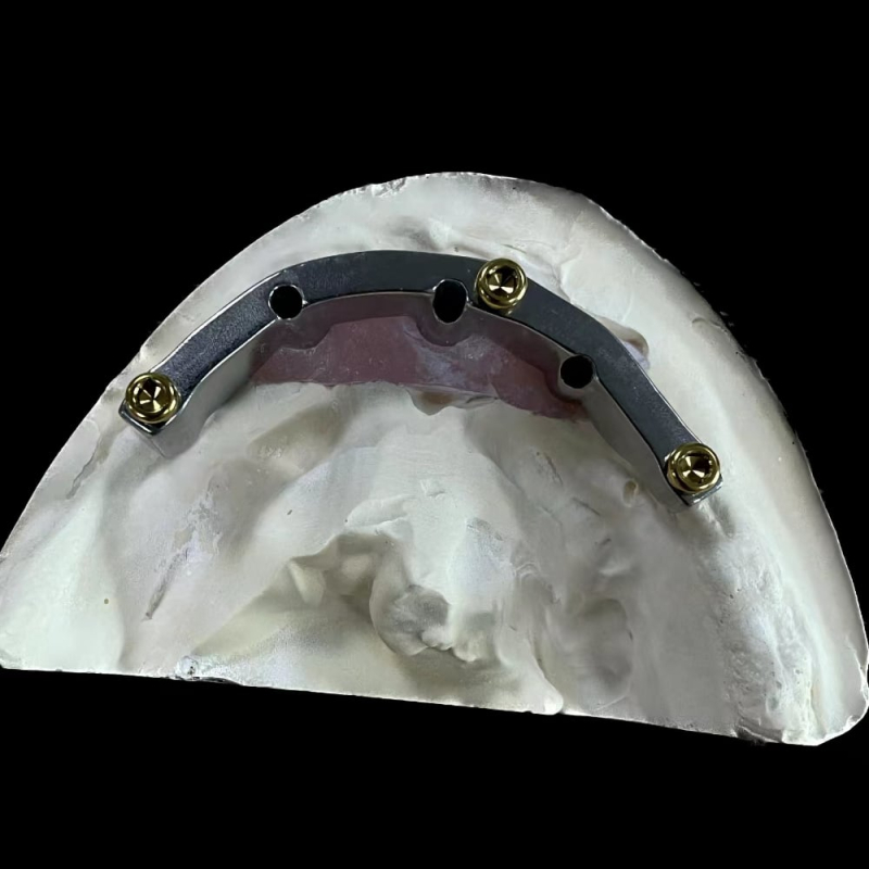 Implant Supported Dentures With Locators - Image 1