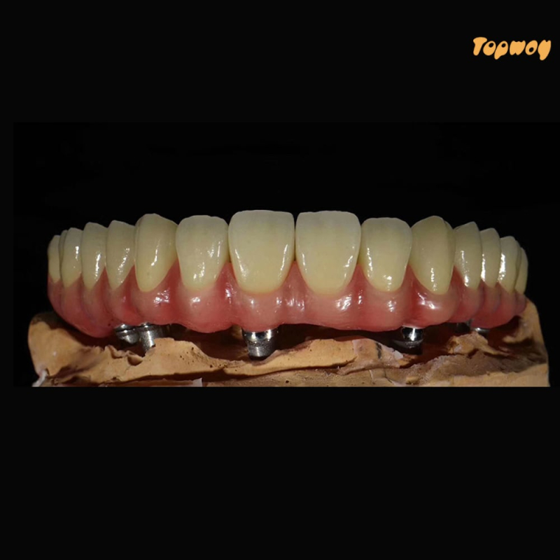 Implant Metal Ceramic Dental Bridges Screwed Retained - Image 1