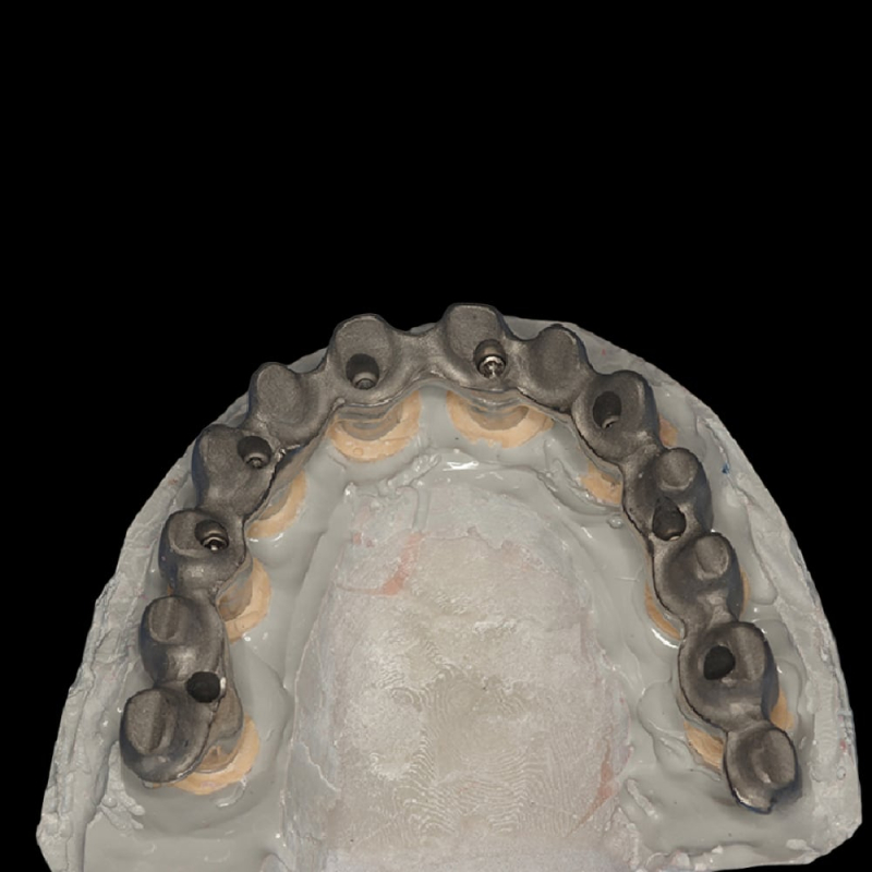 Implant Metal Ceramic Dental Bridges Screwed Retained - Image 2