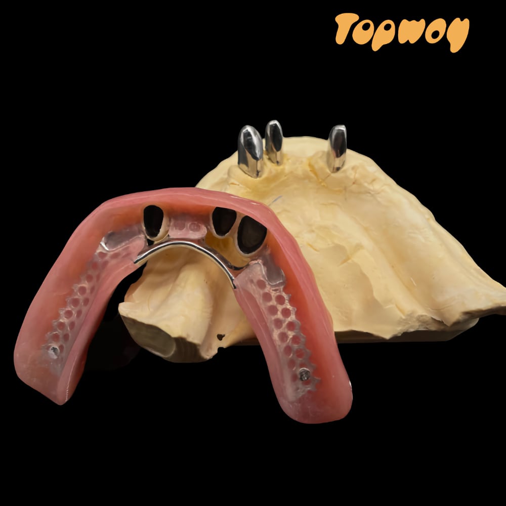 Dental Telescopes Crowns