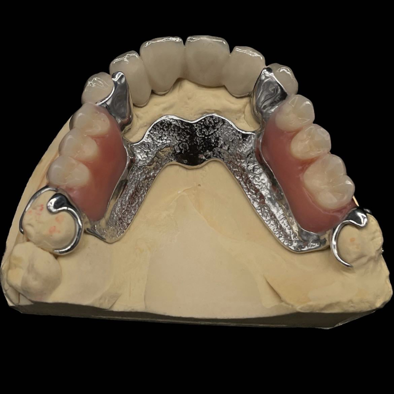 Dental Telescopes Crowns - Image 2