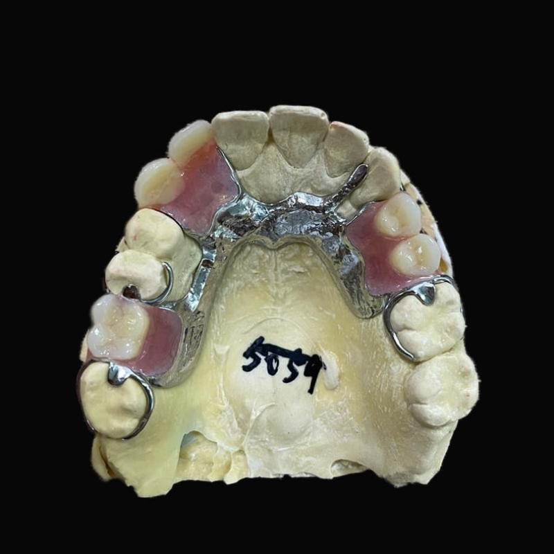 Dental Dentures Metal Framework - Image 3
