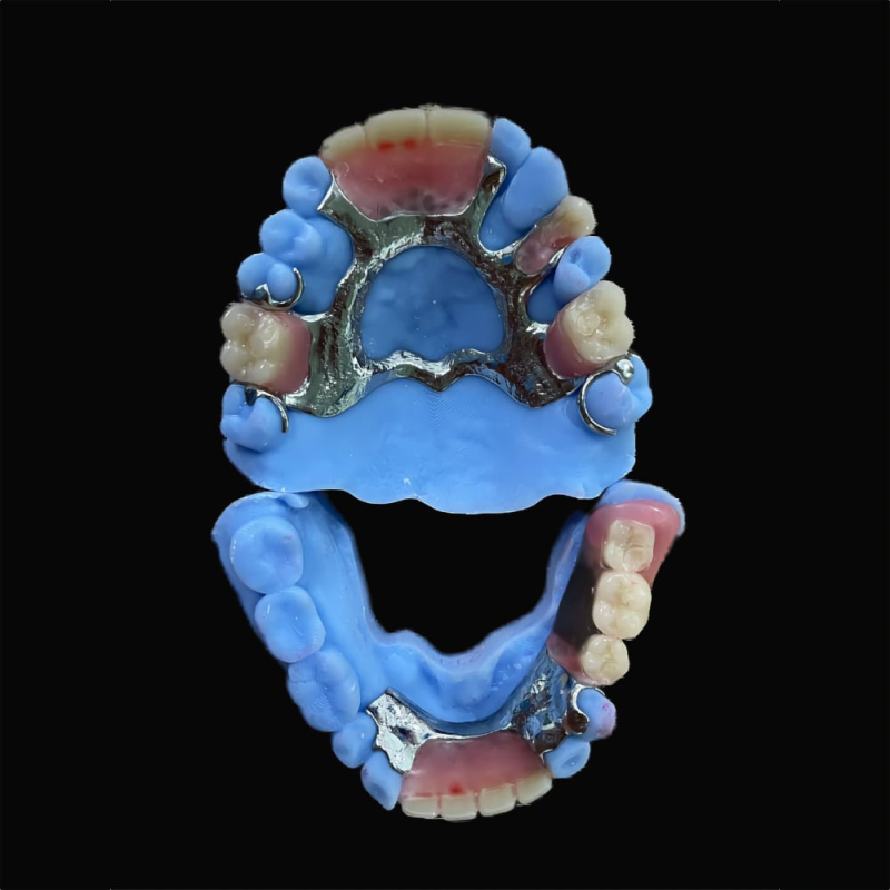 Dental Dentures Metal Framework - Image 4