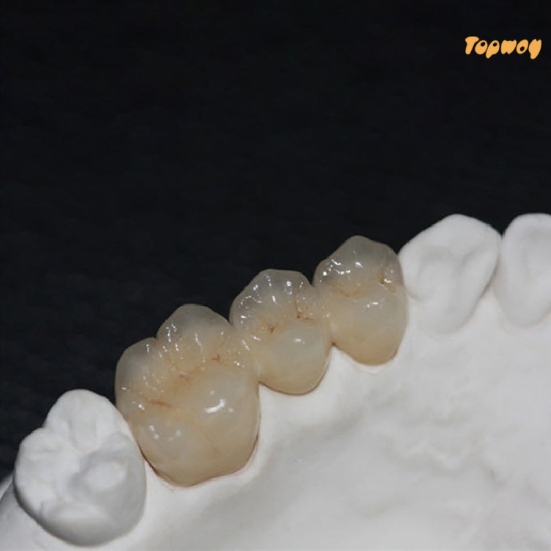 Digital PFM Crowns and Bridge - Image 2