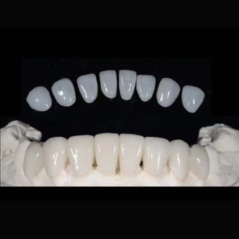 Digital Emax Veneer Esthetics