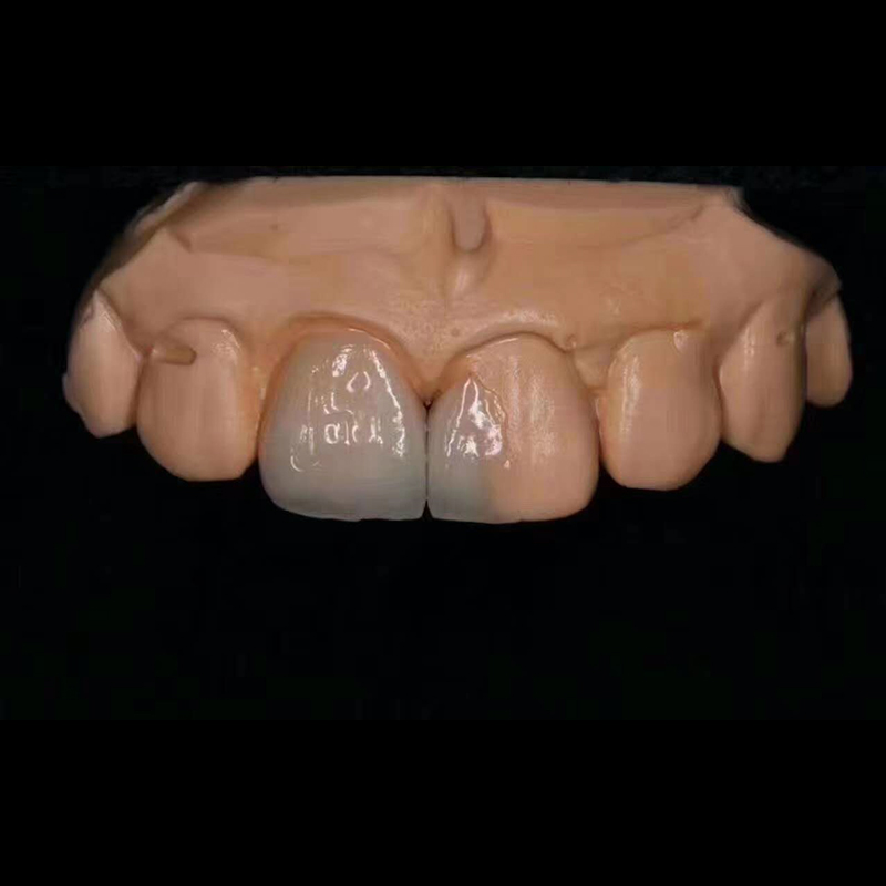 Digital Emax Veneer Esthetics - Image 3