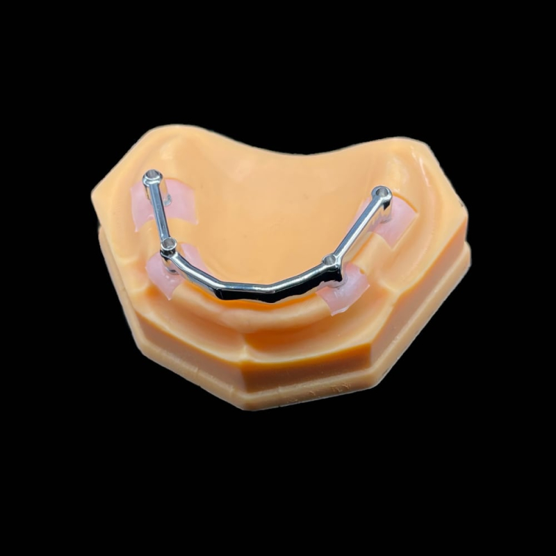 Hybrid Denture With Titanium Bar - Image 1