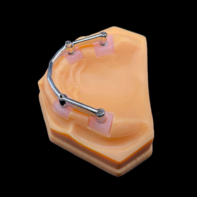 Hybrid Denture With Titanium Bar - Image 3