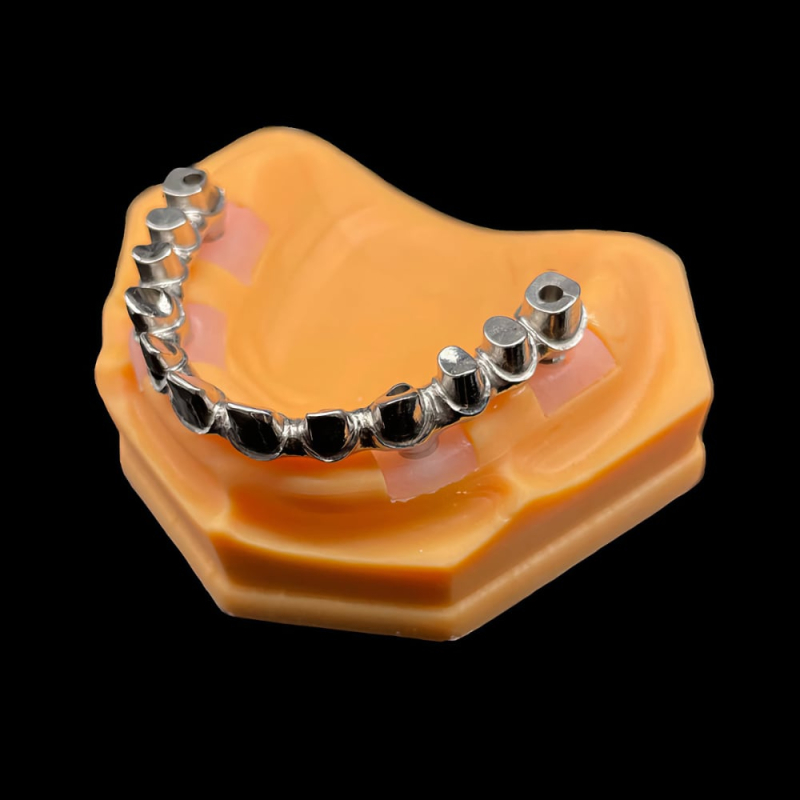 Hybrid Denture With Titanium Bar - Image 4