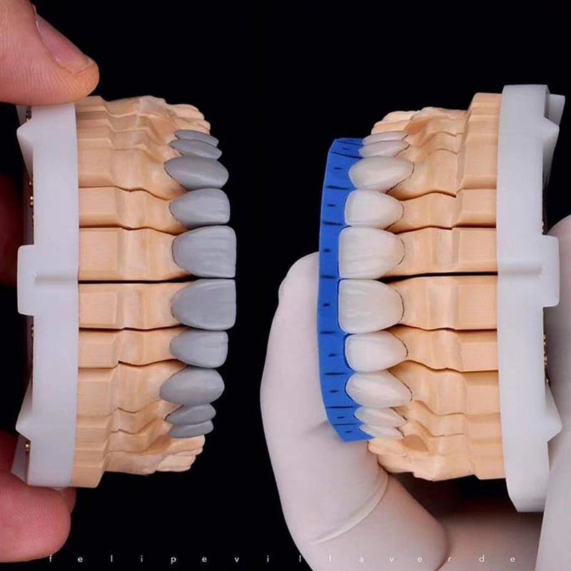 Diagnostic Wax Up - Image 1