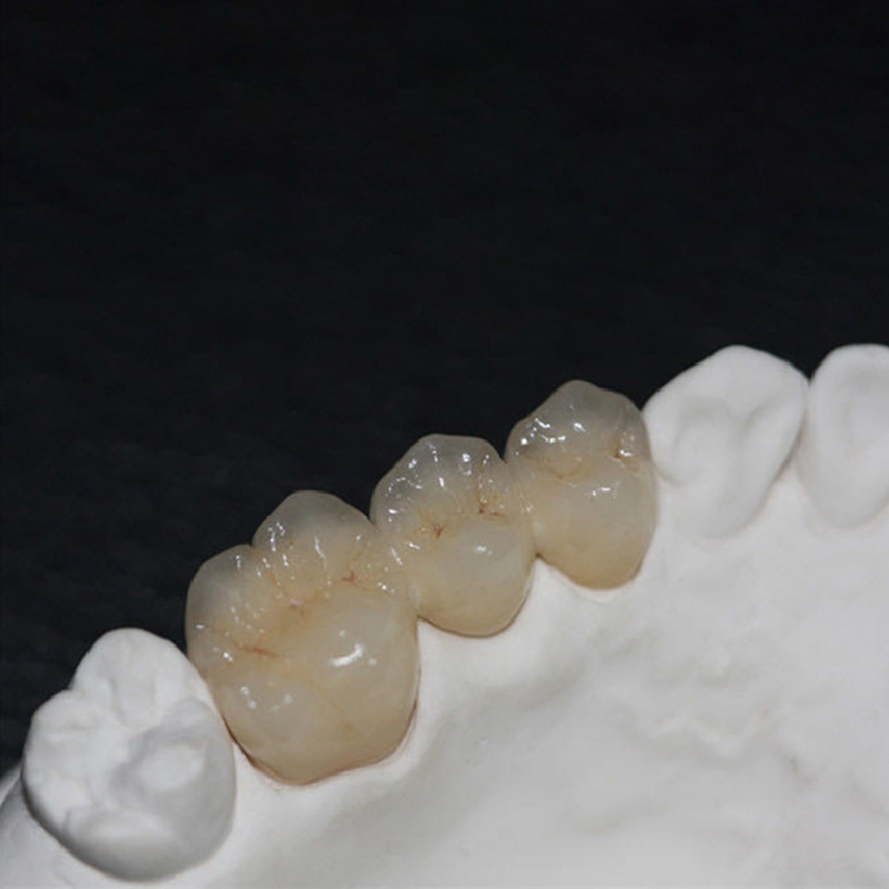 Dental Lab PFM Crowns and Bridge - Image 2