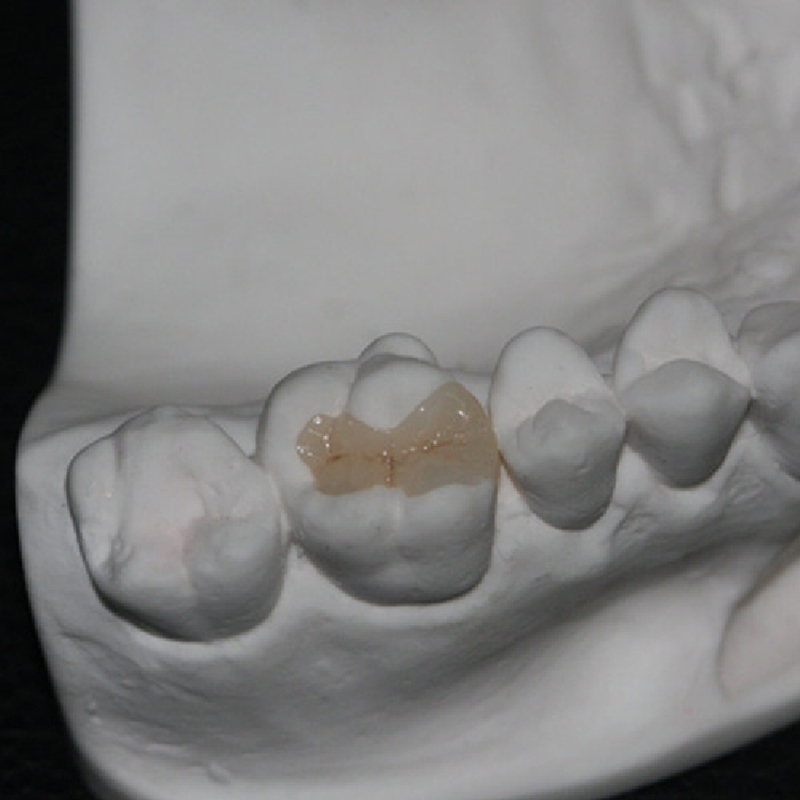 Composite Inlay And Onlay - Image 1