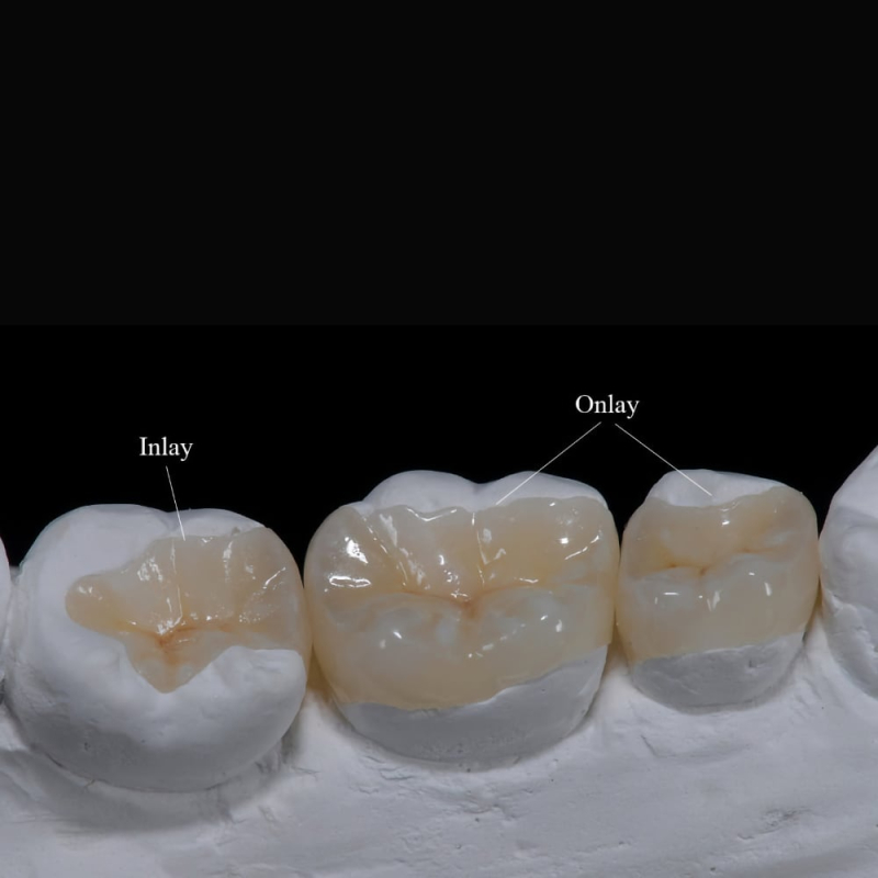 Composite Inlay And Onlay - Image 2