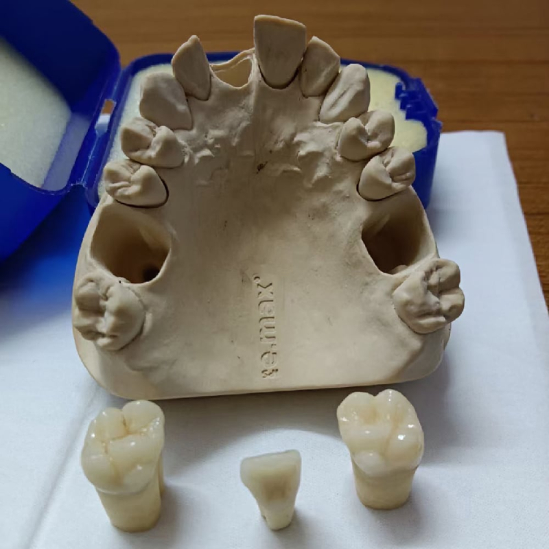 All Ceramic IPS e.max® CAD Crown - Image 2