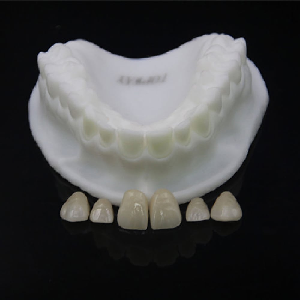 Aesthetic Emax Veneer