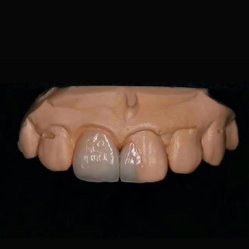 Aesthetic Emax Veneer - Image 2