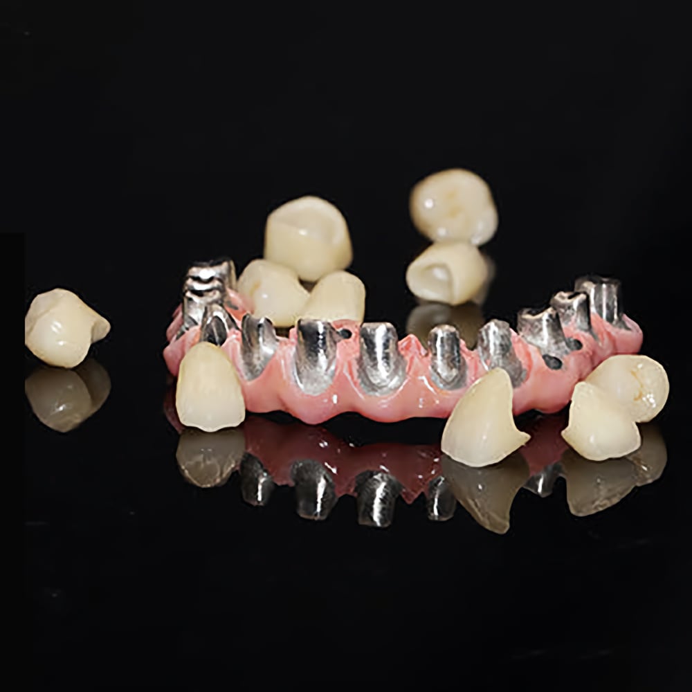 Dental Malo Implant Crown and Bridge Customized