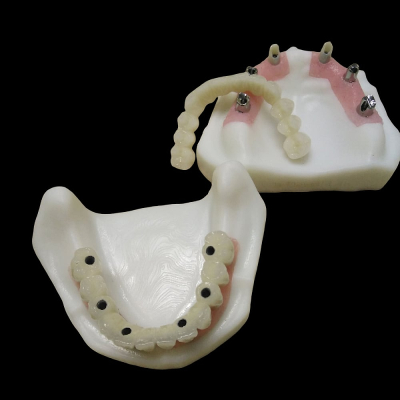 Dental Implant Screw retained Crown and Bridge - Image 1