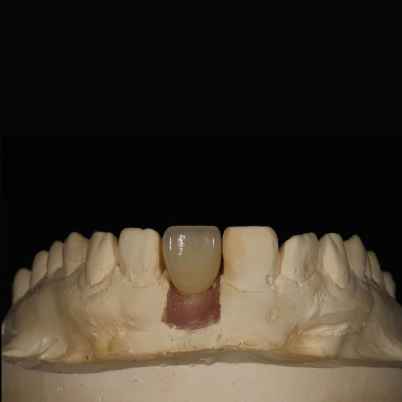 Dental Implant Screw retained Crown and Bridge - Image 2