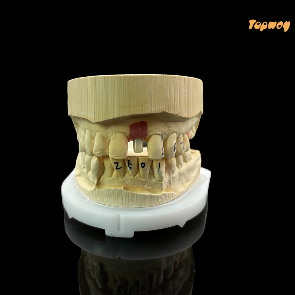 Custom Zirconia Implant Abutment