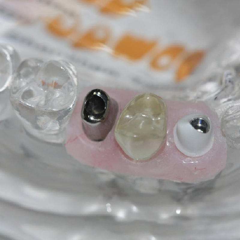 Custom Zirconia Implant Abutment - Image 2