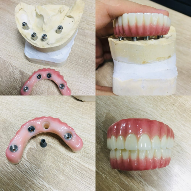 All On 4 Dental Implants - Image 2