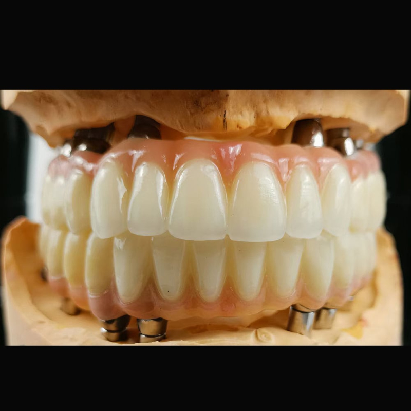 All On 4 Dental Implants - Image 3